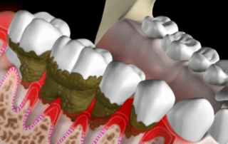 Tooth loosening gum disease