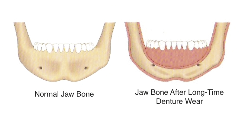 Bone loss due to denture wear implatologist panipat