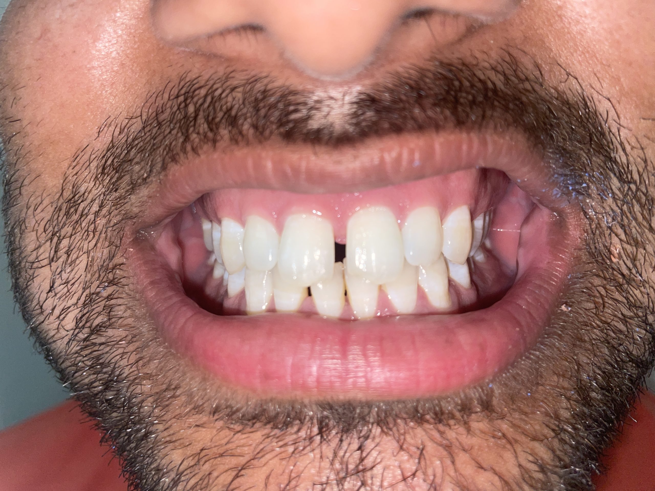 aligner