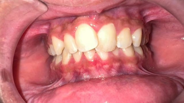 Invisalign
