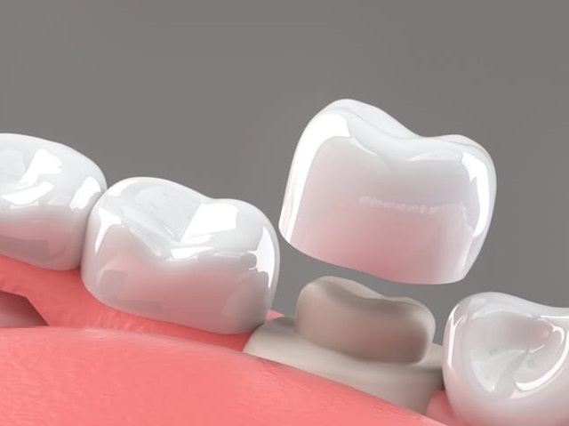dental-crowns-tooth-cap-1735039789853-compressed