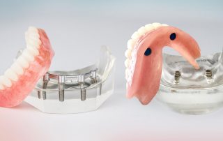 Implant Over dentures
