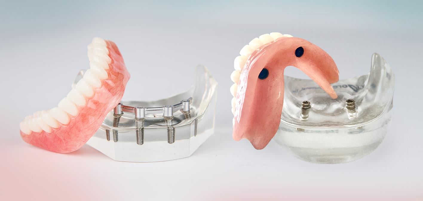 Implant Over dentures - implantology in panipat