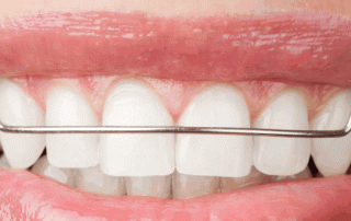 Orthodontic retainer hawleys