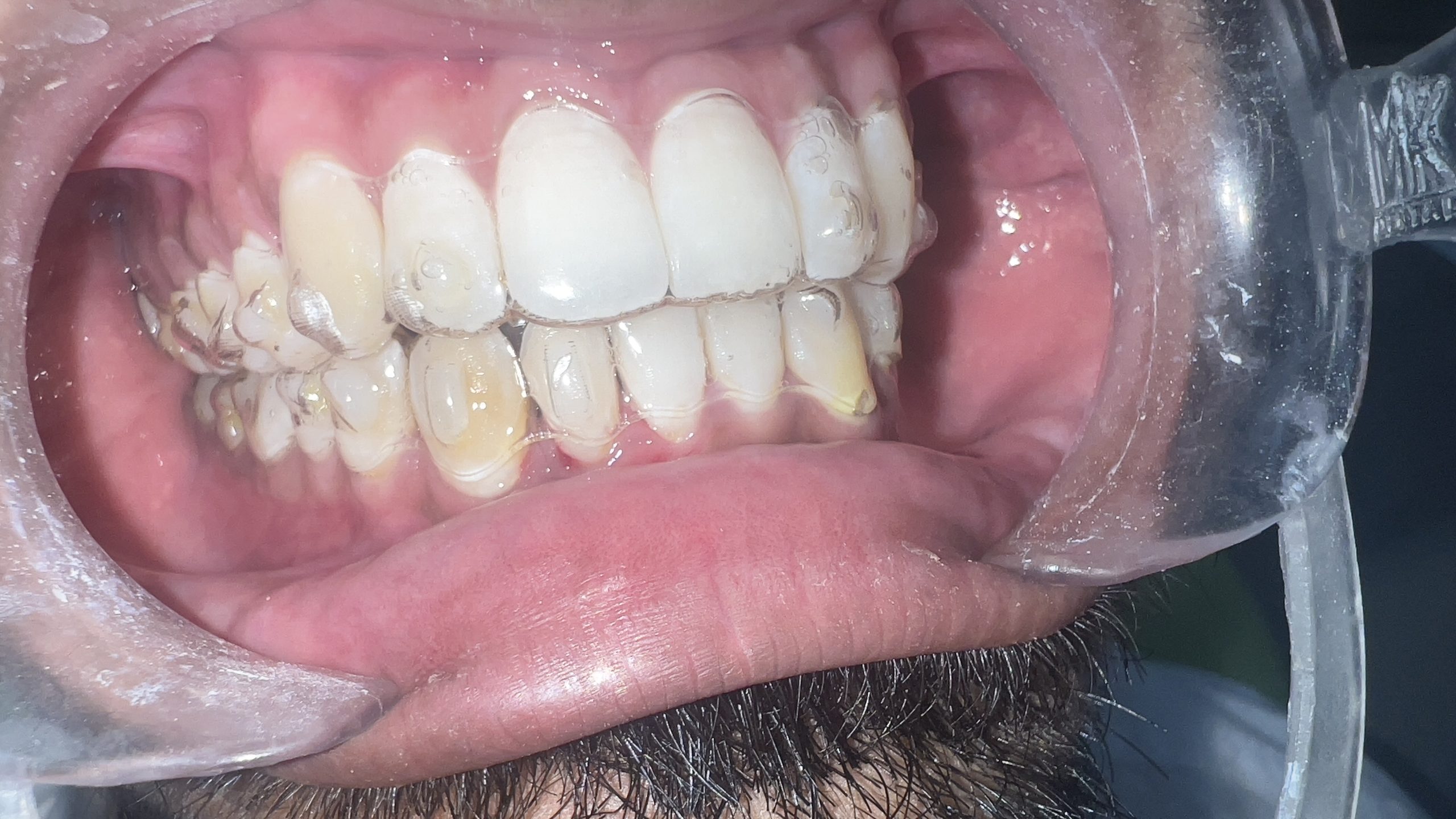 Crowding invisalign case