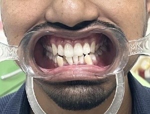 Crowding invisalign