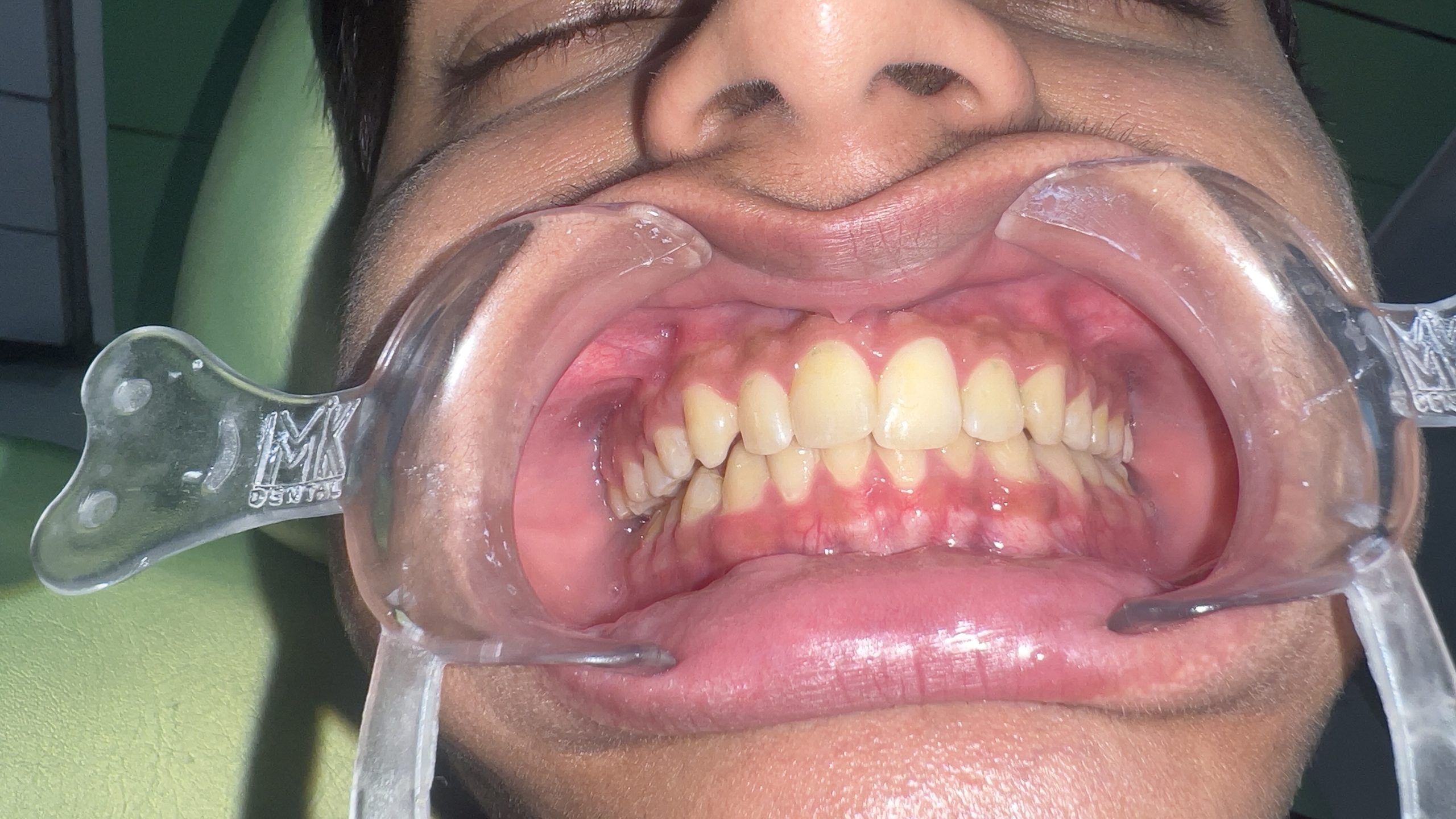 Invisalign