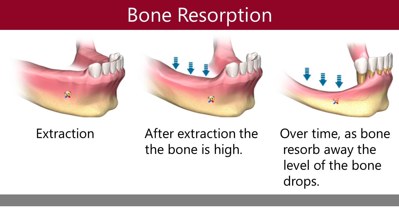 Effect of Bone resorption in missing teeth panipat implantologist