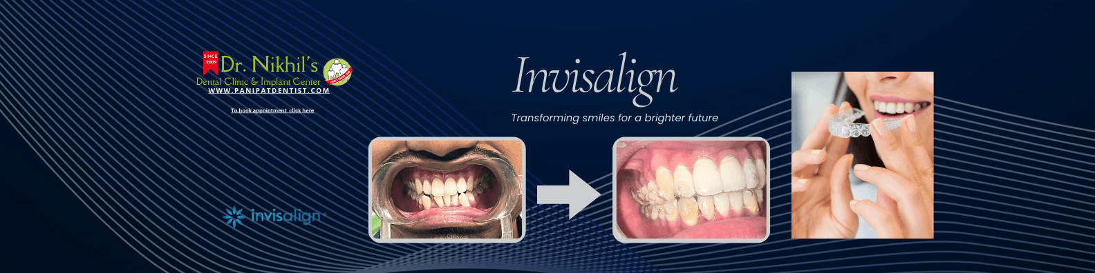 invisalign banner invisalign banner