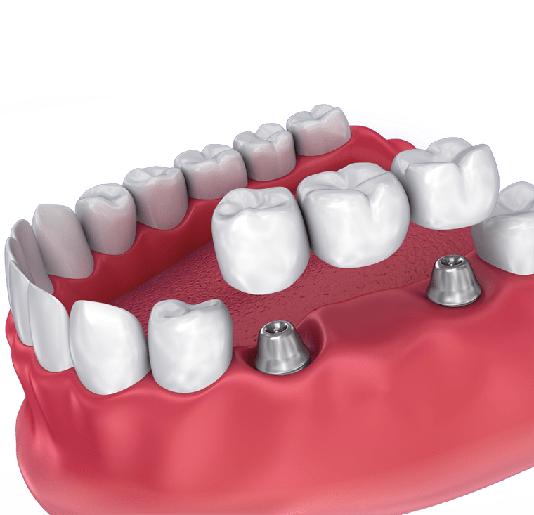 Implant Supported bridge best implantology in panipat