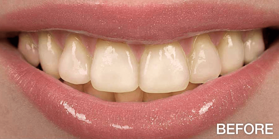 before veneers