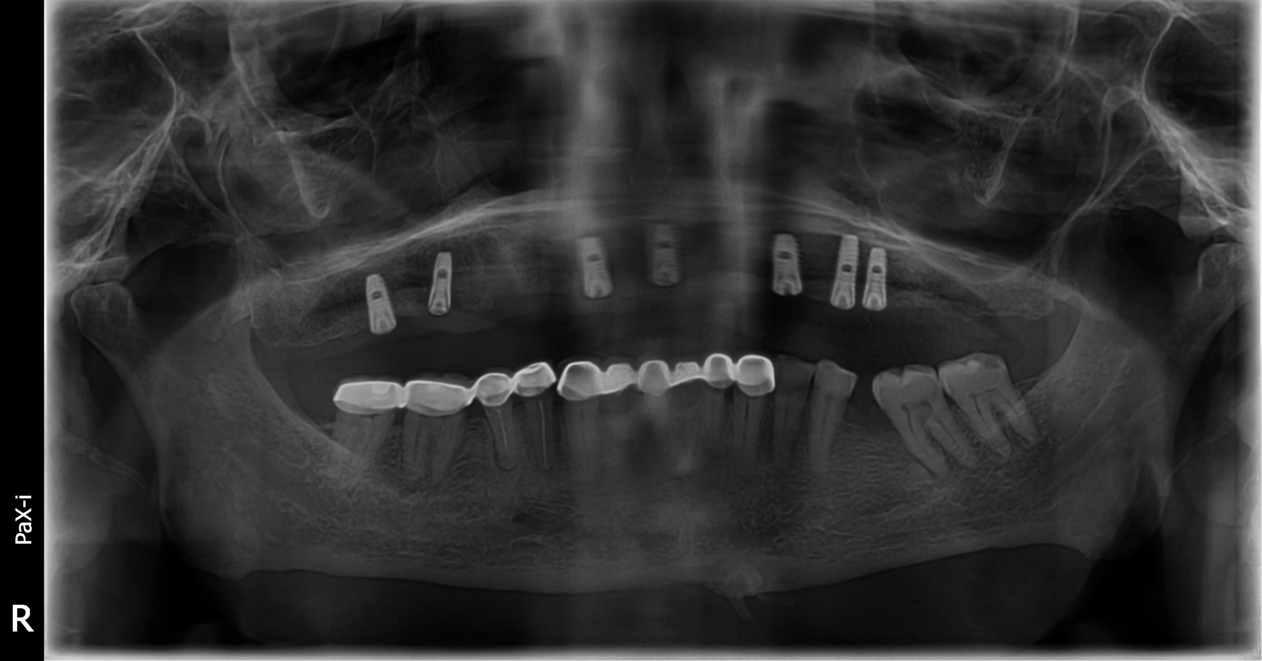 Implants