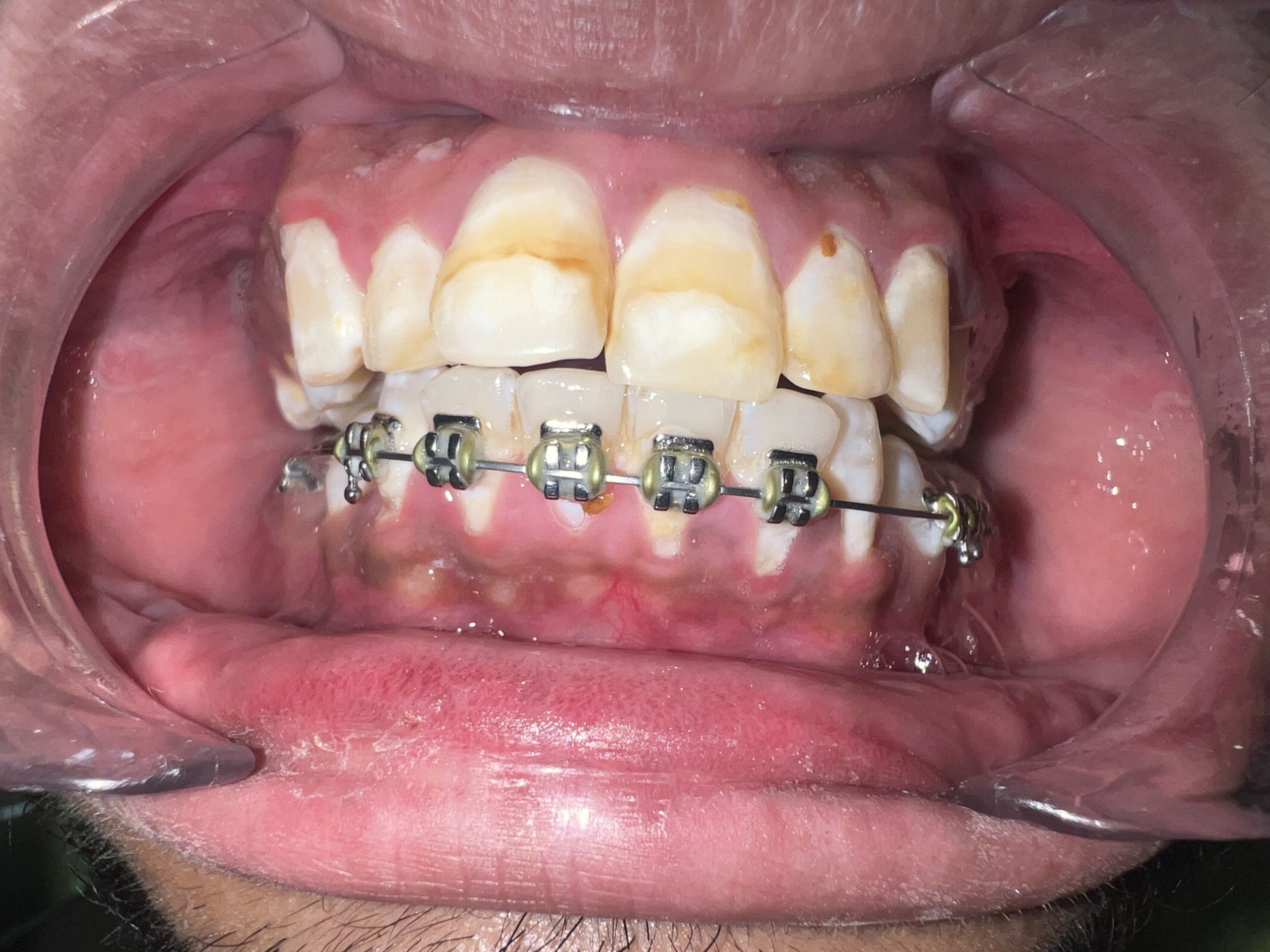 Veneer before Flourosis