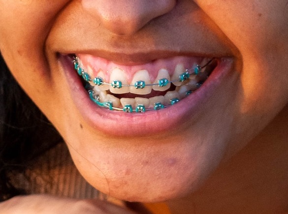 Teeth braces metal