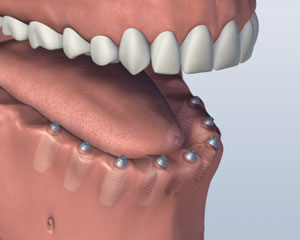 tooth replacement with dental implant in Panipat