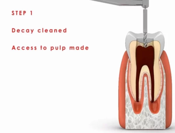123 Painless Root canal treatment In panipat