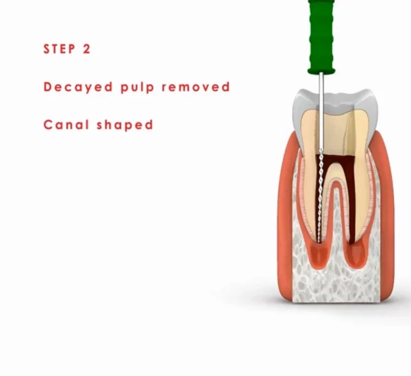 1234 Painless Root canal treatment In panipat